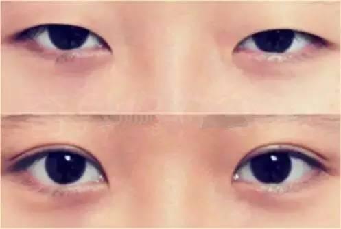 网红黎川双眼皮,揭秘网红眼部魅力秘诀